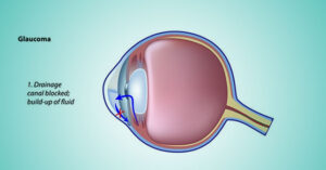 glaucoma-awareness_img