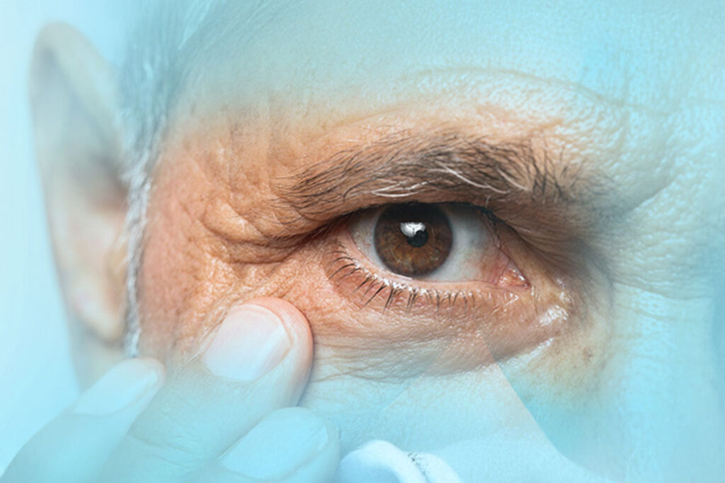 Age-related-Macular-Degeneration