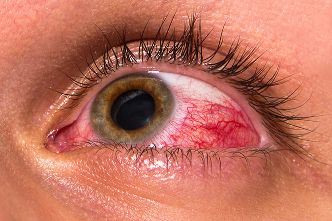 Uveitis & Ocular Inflammation