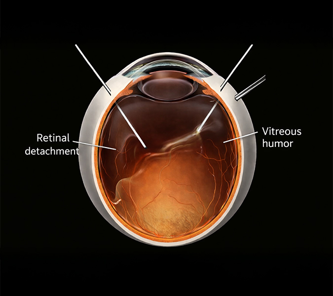 Common Retinal Conditions Treated with Surgery