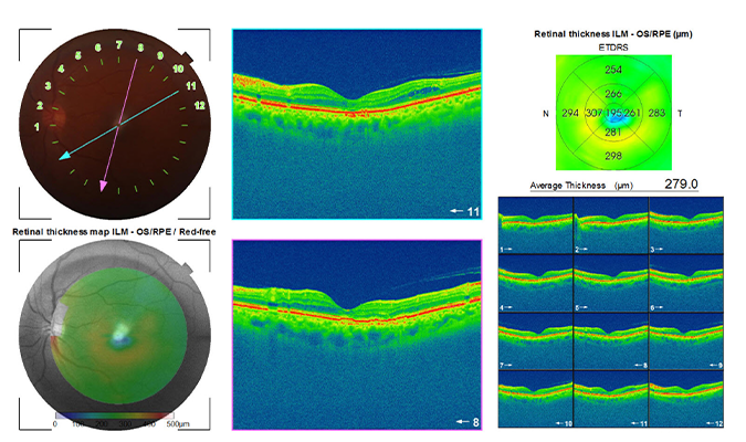 OS OCT REPORT....jpg resizing